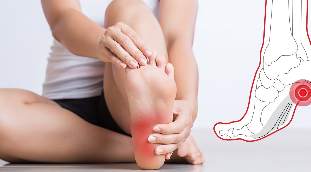 Everything You Need to Know About Plantar Fasciitis